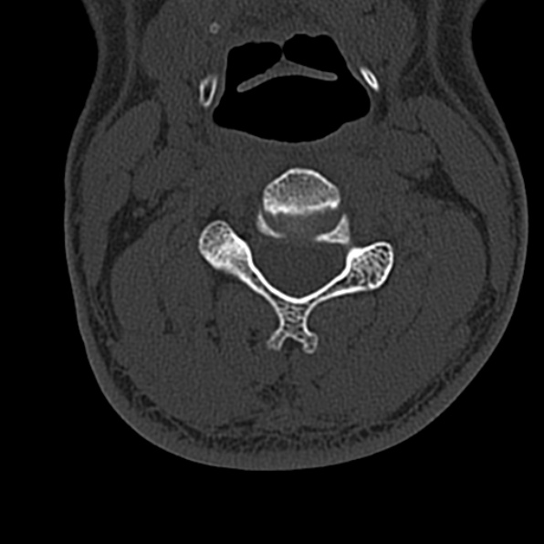 Cervical spondylodiscitis (Radiopaedia 28057-29489 Axial bone window 37).jpg