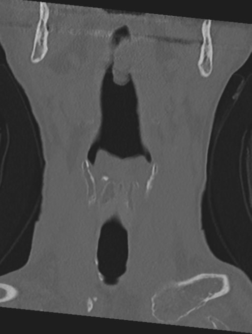 Cervical spondylolysis (Radiopaedia 49616-54811 Coronal bone window 2).png