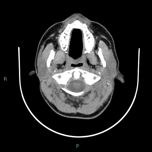 Cervical thymic cyst (Radiopaedia 88632-105335 Axial non-contrast 95).jpg