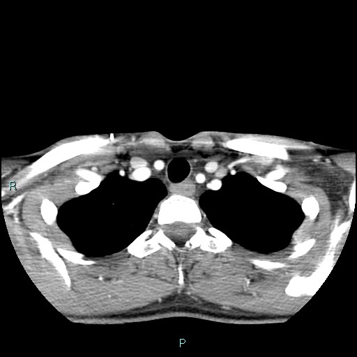Cervical thymic cyst (Radiopaedia 88632-105335 B 26).jpg