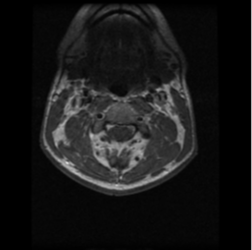 File:Cervical vertebrae metastasis (Radiopaedia 78814-91667 Axial T1 C+ 17).png