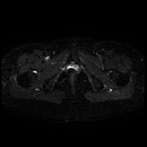 Cesarian section scar endometriosis (Radiopaedia 66520-75799 Axial DWI 24).jpg