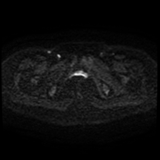 Cesarian section scar endometriosis (Radiopaedia 66520-75799 Axial DWI 73).jpg