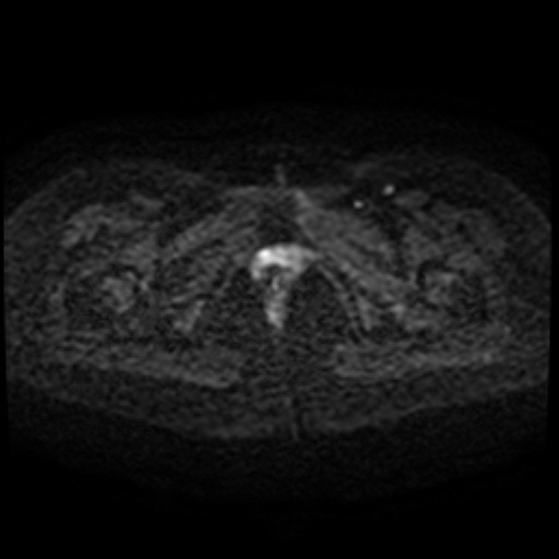 File:Cesarian section scar endometriosis (Radiopaedia 66520-75799 Axial DWI 75).jpg