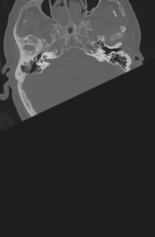 Chalk stick fracture (Radiopaedia 57948-64928 Axial bone window 3).png