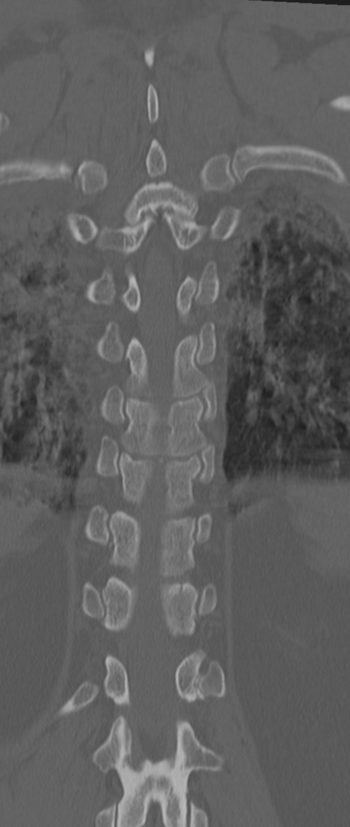 Chance fracture (Radiopaedia 33854-35020 Coronal bone window 61).png