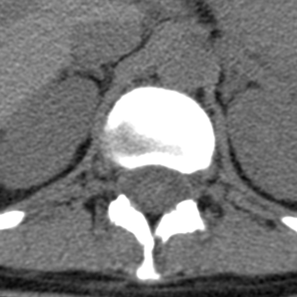 File:Chance fracture (Radiopaedia 36521-38081 Axial non-contrast 62).jpg