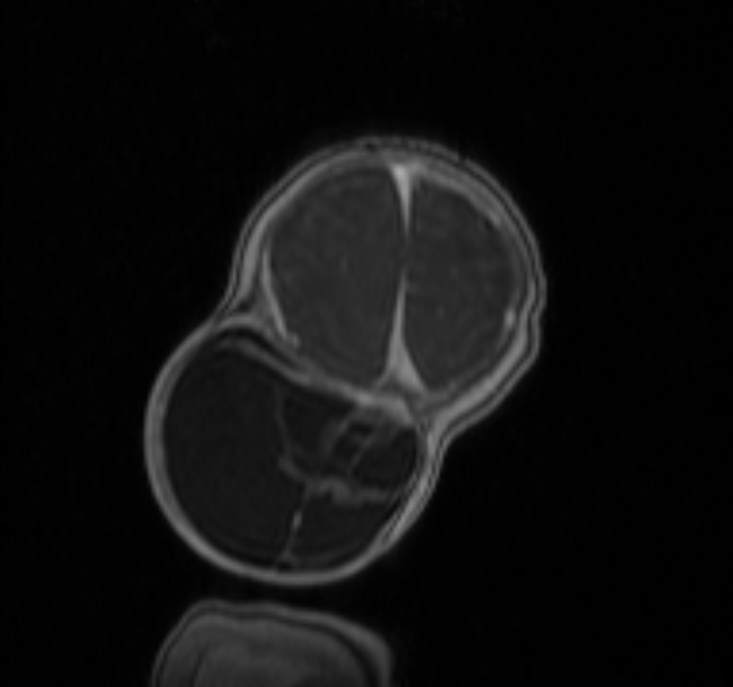 Chiari III malformation with occipital encephalocele (Radiopaedia 79446-92559 Coronal T1 C+ mpr 47).jpg