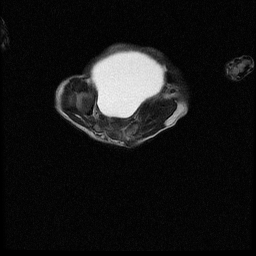 File:Chiari II malformation with spinal meningomyelocele (Radiopaedia 23550-23652 Axial T2 17).jpg