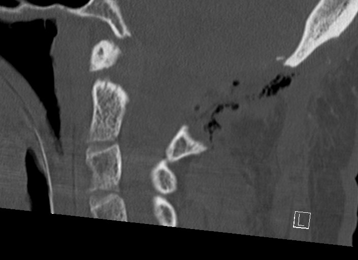 Chiari I malformation with a symptomatic syrinx of the posterolateral medulla oblongata (Radiopaedia 42573-45707 A 34).jpg