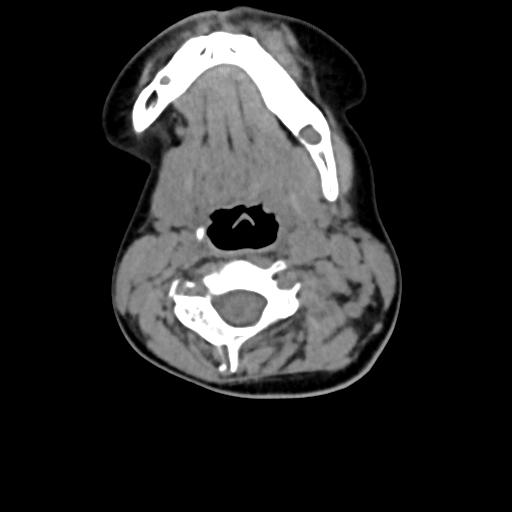 Chiari I with syrinx and skull base anomalies (Radiopaedia 89444-106412 Axial non-contrast 78).jpg