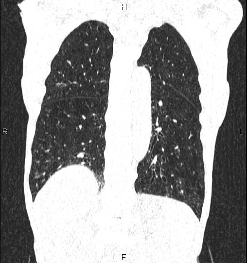 Chilaiditi sign (Radiopaedia 88839-105611 Coronal lung window 47).jpg