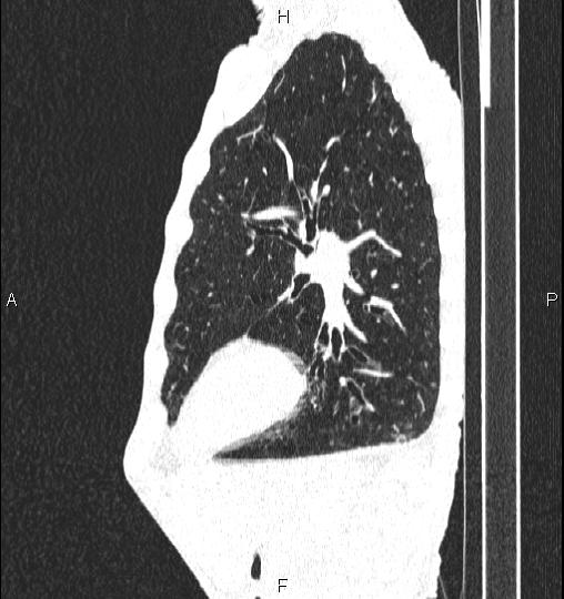 Chilaiditi sign (Radiopaedia 88839-105611 Sagittal lung window 70).jpg