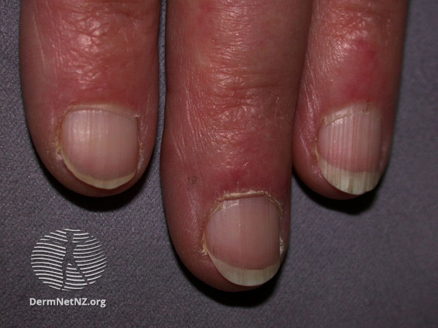 File:Chilblain lupus (DermNet NZ immune-le-nailfolds).jpg