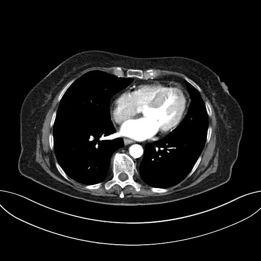 Cholecystoduodenal fistula due to calculous cholecystitis with gallstone migration (Radiopaedia 86875-103077 A 2).jpg