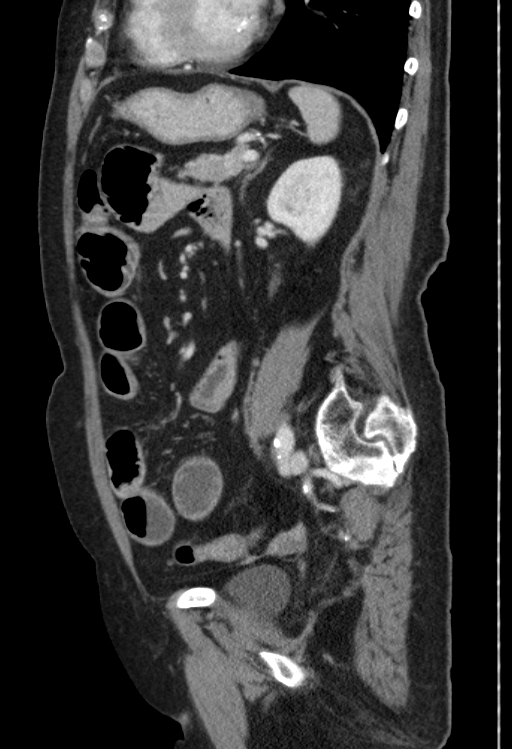 Cholecystoduodenal fistula due to calculous cholecystitis with gallstone migration (Radiopaedia 86875-103077 F 21).jpg