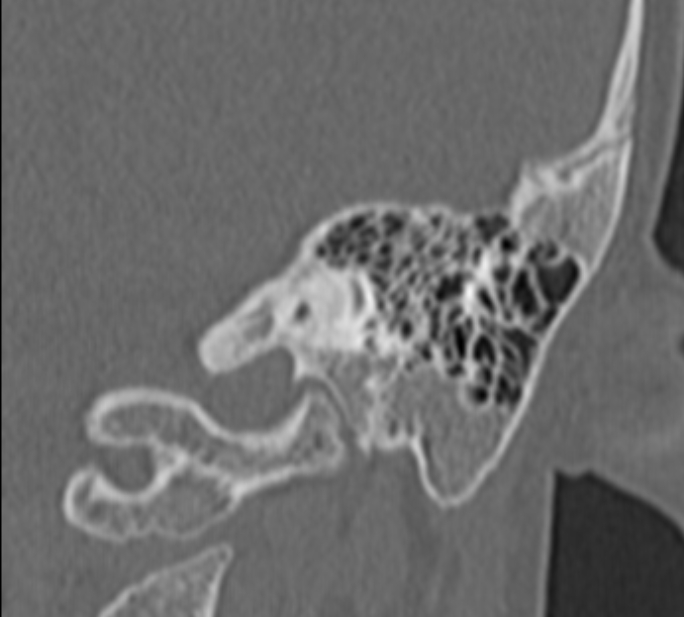 Cholesteatoma (Radiopaedia 73023-83750 Coronal Left ear 58).jpg