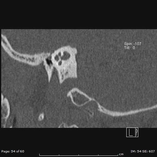 Cholesteatoma - external auditory canal (Radiopaedia 88452-105096 Sagittal bone window 54).jpg
