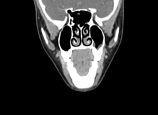 Chondroblastic osteosarcoma (Radiopaedia 67363-76741 D 36).jpg