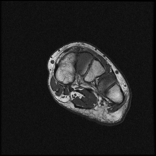 File:Chondroblastoma - midfoot (Radiopaedia 64831-73765 Short axis T1 16).jpg