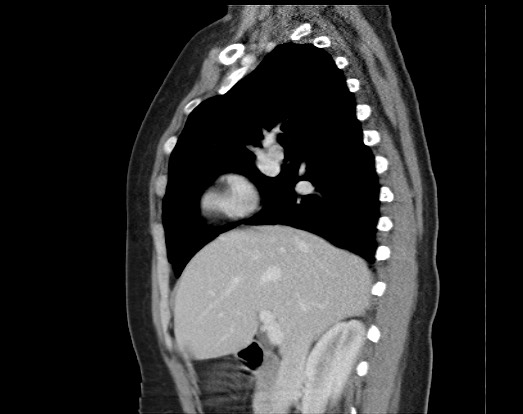 Chondrosarcoma - chest wall (Radiopaedia 65192-74199 B 38).jpg