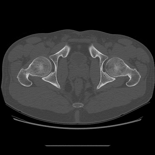 File:Chondrosarcoma of iliac wing (Radiopaedia 63861-72599 Axial bone window 108).jpg