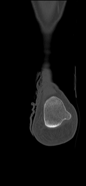 Chopart fracture (Radiopaedia 35347-36851 Coronal bone window 7).jpg