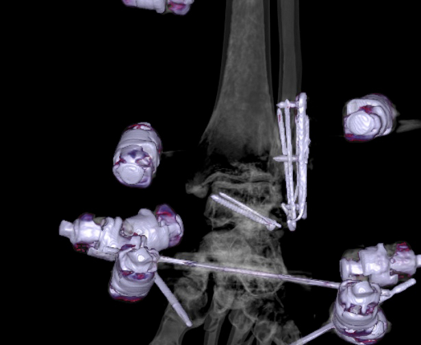 File:Chopart fracture (Radiopaedia 35347-36861 3D MPR bone window 2).jpg