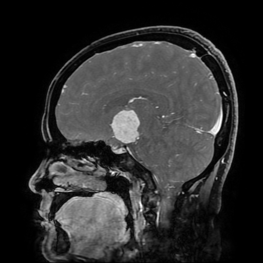 File:Chordoid glioma of third ventricle (Radiopaedia 91612-109340 F 99).jpg
