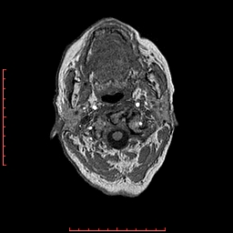 Choroid plexus xanthogranuloma (Radiopaedia 67843-77270 Axial T1 161).jpg