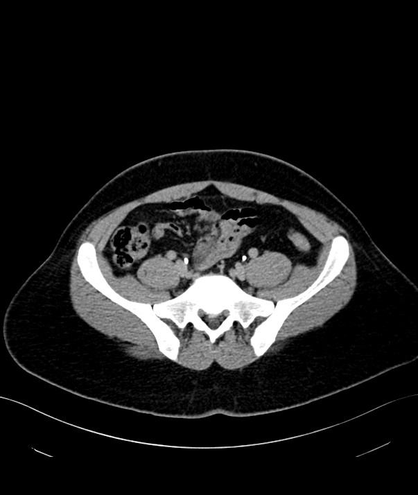 Chromophobe renal cell carcinoma (Radiopaedia 84255-99542 H 43).jpg