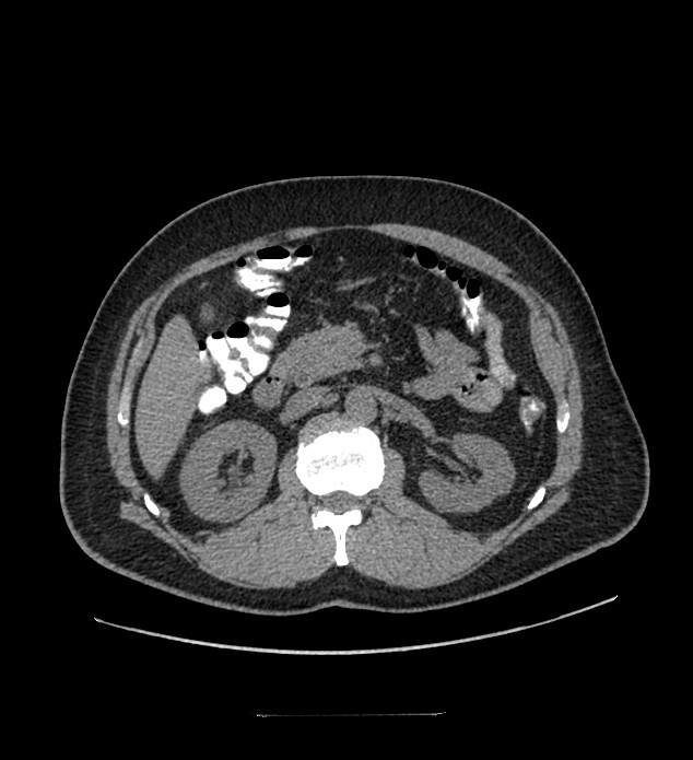 Chromophobe renal cell carcinoma (Radiopaedia 84337-99644 Axial non-contrast 38).jpg