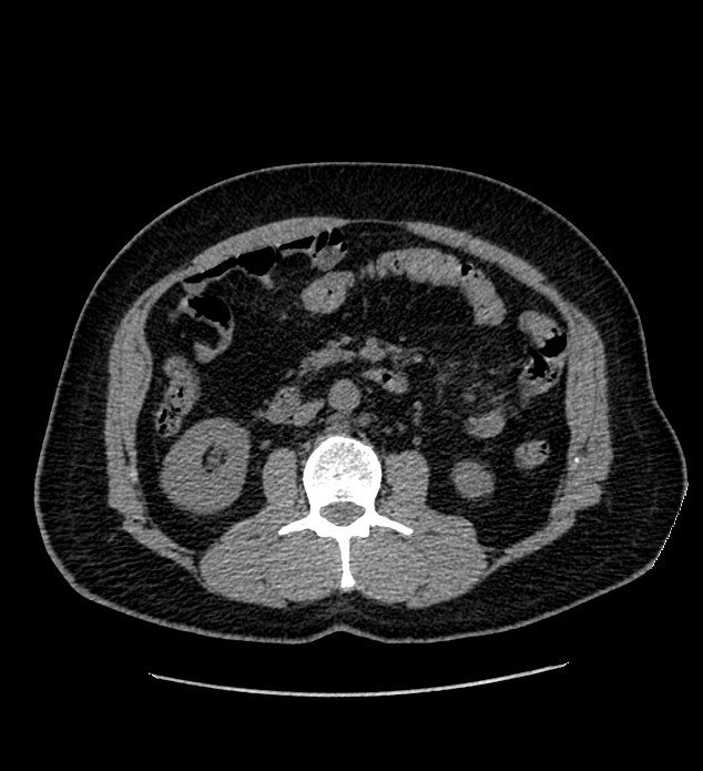 Chromophobe renal cell carcinoma (Radiopaedia 84337-99693 Axial non-contrast 64).jpg