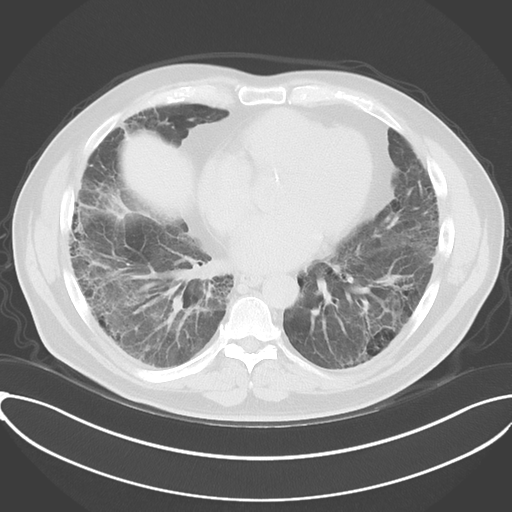 Chronic hypersensitivity pneumonitis (Radiopaedia 48107-52922 Axial lung window 39).png