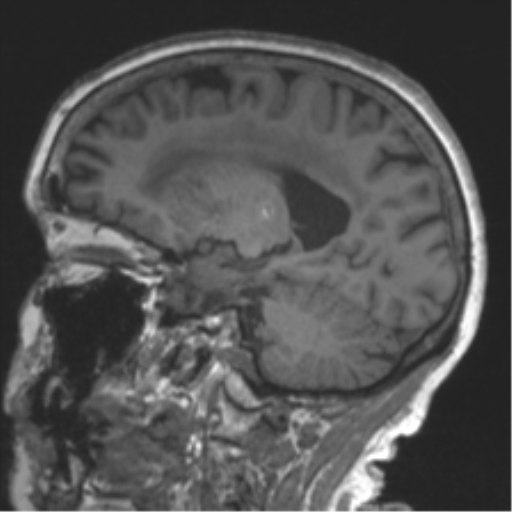 Chronic hypertensive encephalopathy (Radiopaedia 39993-42482 Sagittal T1 38).png