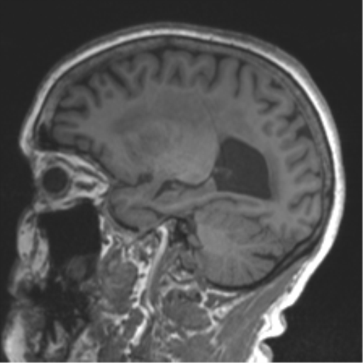 Chronic hypertensive encephalopathy (Radiopaedia 39993-42482 Sagittal T1 61).png