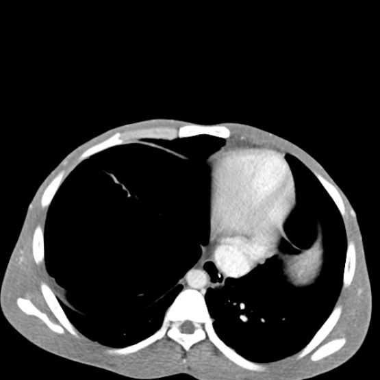 File:Chronic large bowel pseudo-obstruction (Radiopaedia 43181-46492 A 29).jpg