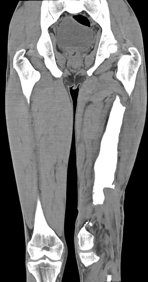 Chronic osteomyelitis (with sequestrum) (Radiopaedia 74813-85822 E 34).jpg