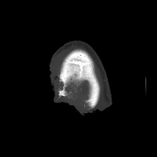 Chronic osteomyelitis - calvarial (severe) (Radiopaedia 69668-79616 Axial bone window 69).jpg