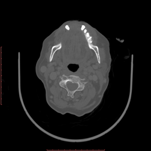 Chronic osteomyelitis - maxilla (Radiopaedia 23783-23927 Axial bone window 39).jpg