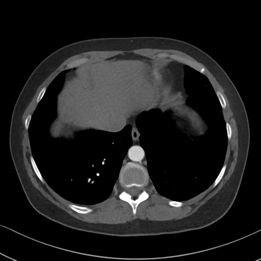 Chronic pulmonary embolus (Radiopaedia 39129-41341 Axial C+ CTPA 81).png