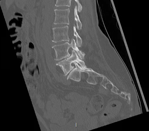 File:Chronic spinal hematoma with cauda equina syndrome (Radiopaedia 75745-88197 Sagittal bone window 19).png