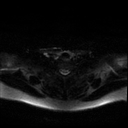 Chronic submandibular sialadenitis (Radiopaedia 61852-69885 Axial DWI 56).jpg