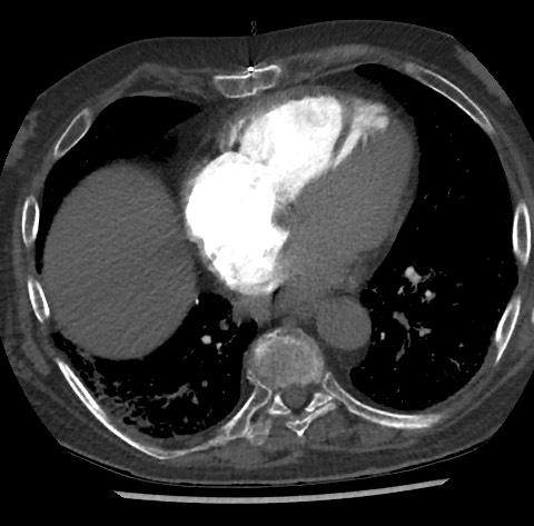 Chronic thromboembolic pulmonary disease (Radiopaedia 90694-108119 Axial C+ CTPA 65).jpg