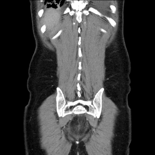 File:Chronic ureteropelvic junction obstruction (Radiopaedia 78365-90996 B 87).jpg