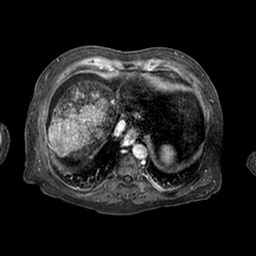 Cirrhosis and hepatocellular carcinoma in the setting of hemochromatosis (Radiopaedia 75394-86594 Axial T1 C+ fat sat 240).jpg