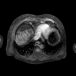 Cirrhosis and hepatocellular carcinoma in the setting of hemochromatosis (Radiopaedia 75394-86594 Axial T1 C+ fat sat 332).jpg
