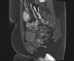 File:Class II Mullerian duct anomaly- unicornuate uterus with rudimentary horn and non-communicating cavity (Radiopaedia 39441-41755 G 33).jpg
