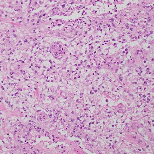 File:Clear cell meningoma - lumbar spine (Radiopaedia 60116-78655 H&E 1).jpg
