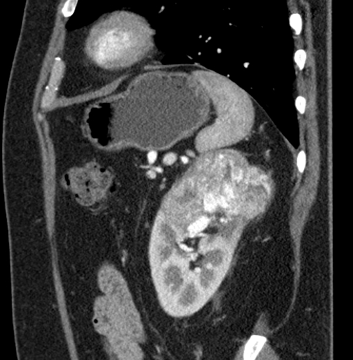 File:Clear cell renal cell carcinoma (Radiopaedia 61449-69393 D 19).jpg